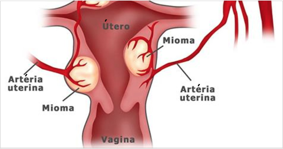 cistos_e_mioma